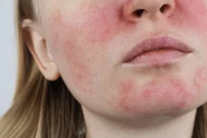 Dermatīts
