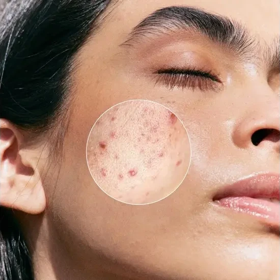 Janssen Cosmetics Purifying BHA Serum | Serums ar Salicilskābi Problemātiskai Ādai, 30 ml