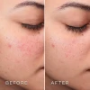 Medik8 Press & Clear Refill | Uzpildāms BHA toniks problemātiskai ādai 150 ml
