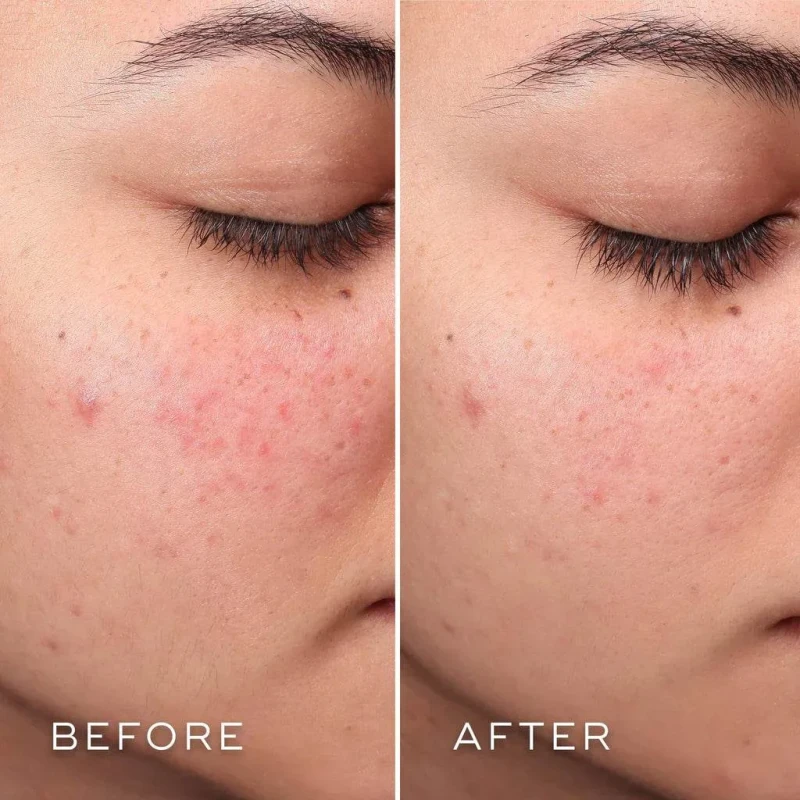 Medik8 Press & Clear Refill | Uzpildāms BHA toniks problemātiskai ādai 150 ml